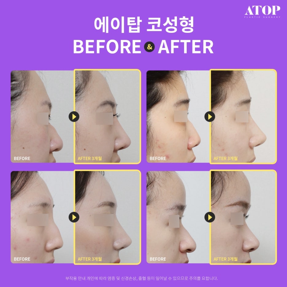 매부리코수술후기 내게 맞는 코 모양을 찾아 관련 이미지 7