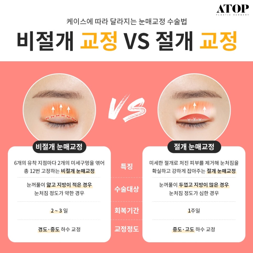 자연유착쌍수후기 핏한 쌍꺼풀과 트임으로 자연스럽게 관련 이미지 6