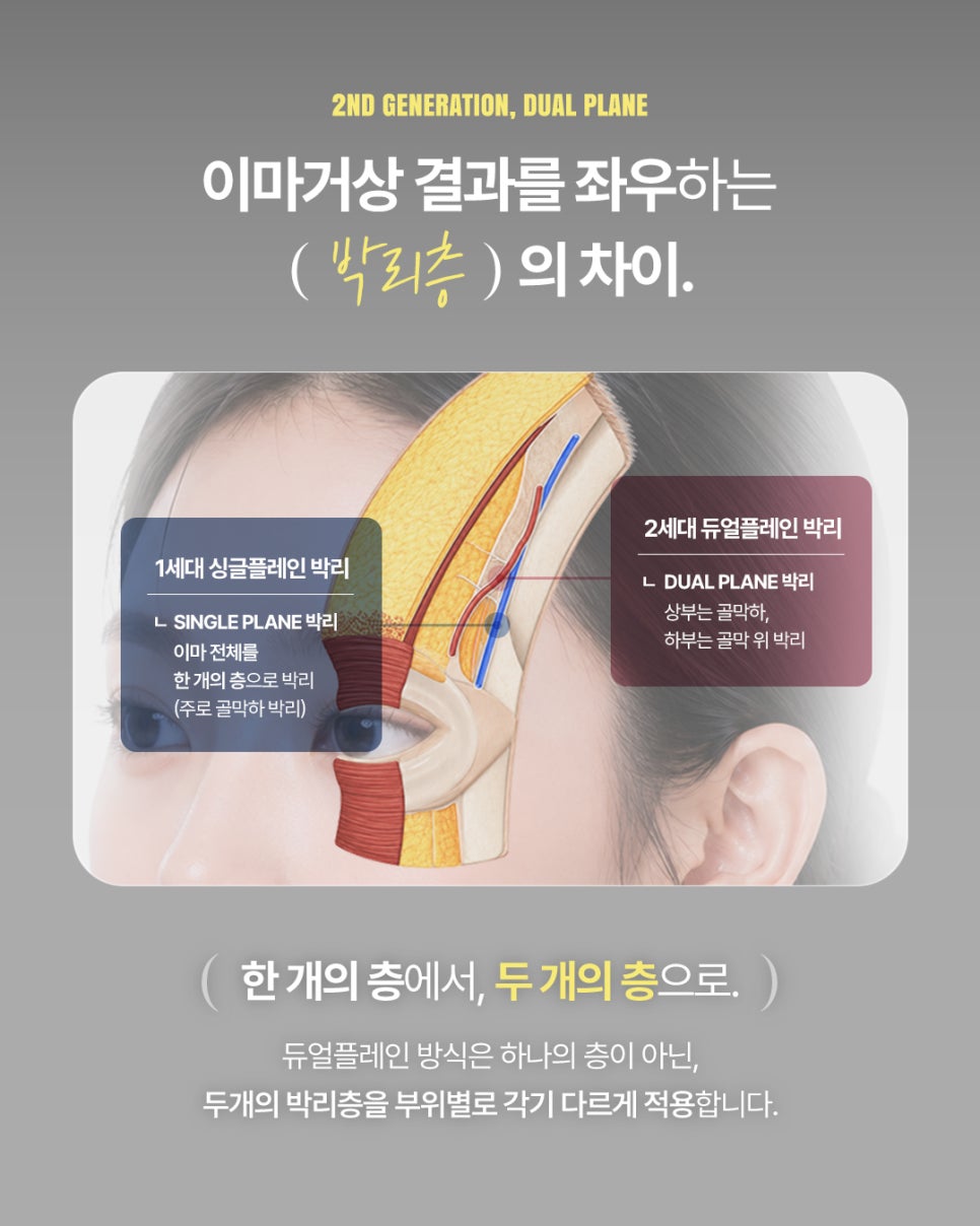 The 5-Point Incisions Remain the Same, but the Dissection Planes Are Different｜Second-Generation Dual-Plane Forehead Lift image 4