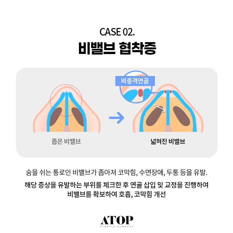 기능코성형수술로 해결할 수 있는 질환은? 관련 이미지 4