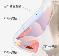 자가늑연골 코성형, 내 코에 어울리는 정교함 관련 이미지 2