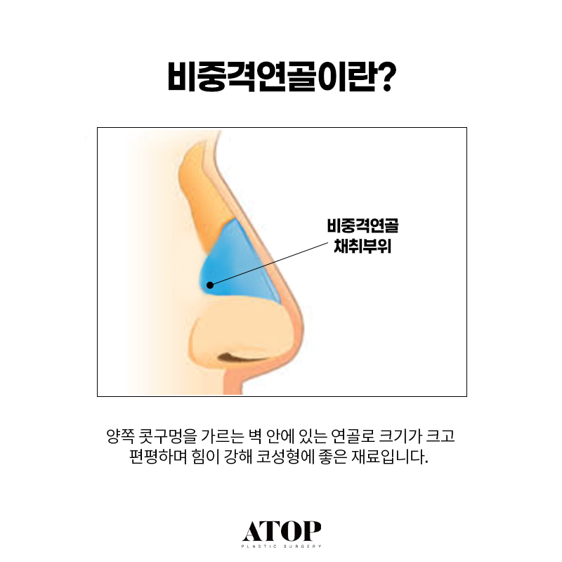 비중격연골 코끝수술 장단점, 의료진의 연골 선택 기준 관련 이미지 2