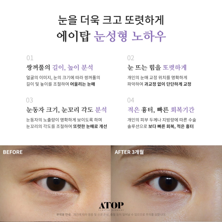 쌍수재수술가격 자연스러운 눈으로 관련 이미지 3