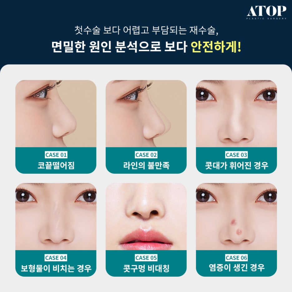 코재수술병원 변형된 코 원래 모습대로 관련 이미지 2