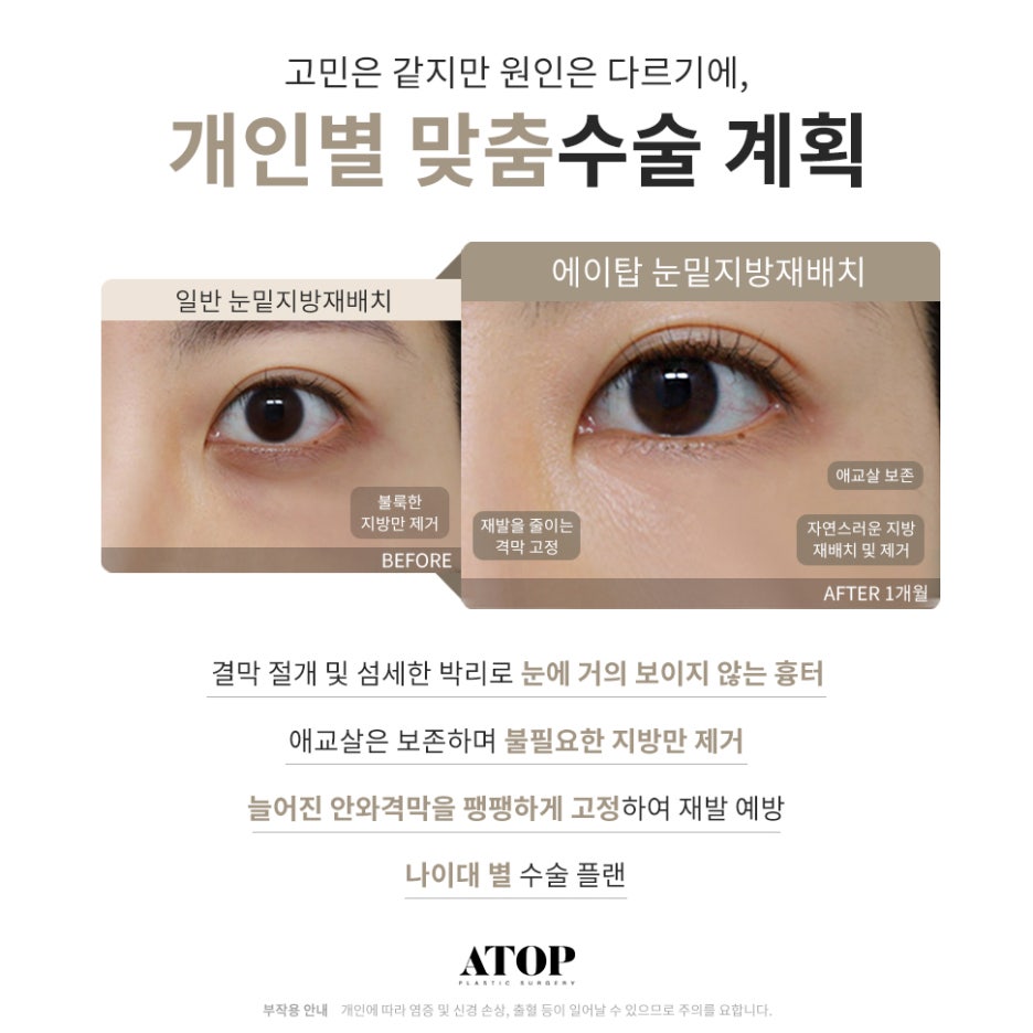 강남역눈밑지방재배치 어두운 인상을 밝고 환하게 관련 이미지 2