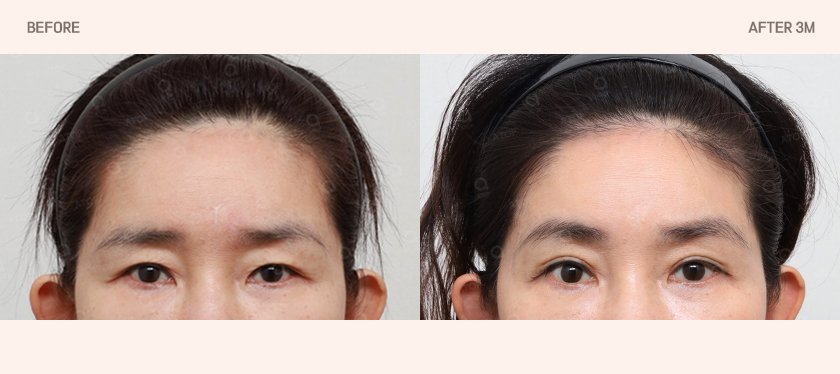 The 5-Point Incisions Remain the Same, but the Dissection Planes Are Different｜Second-Generation Dual-Plane Forehead Lift image 3