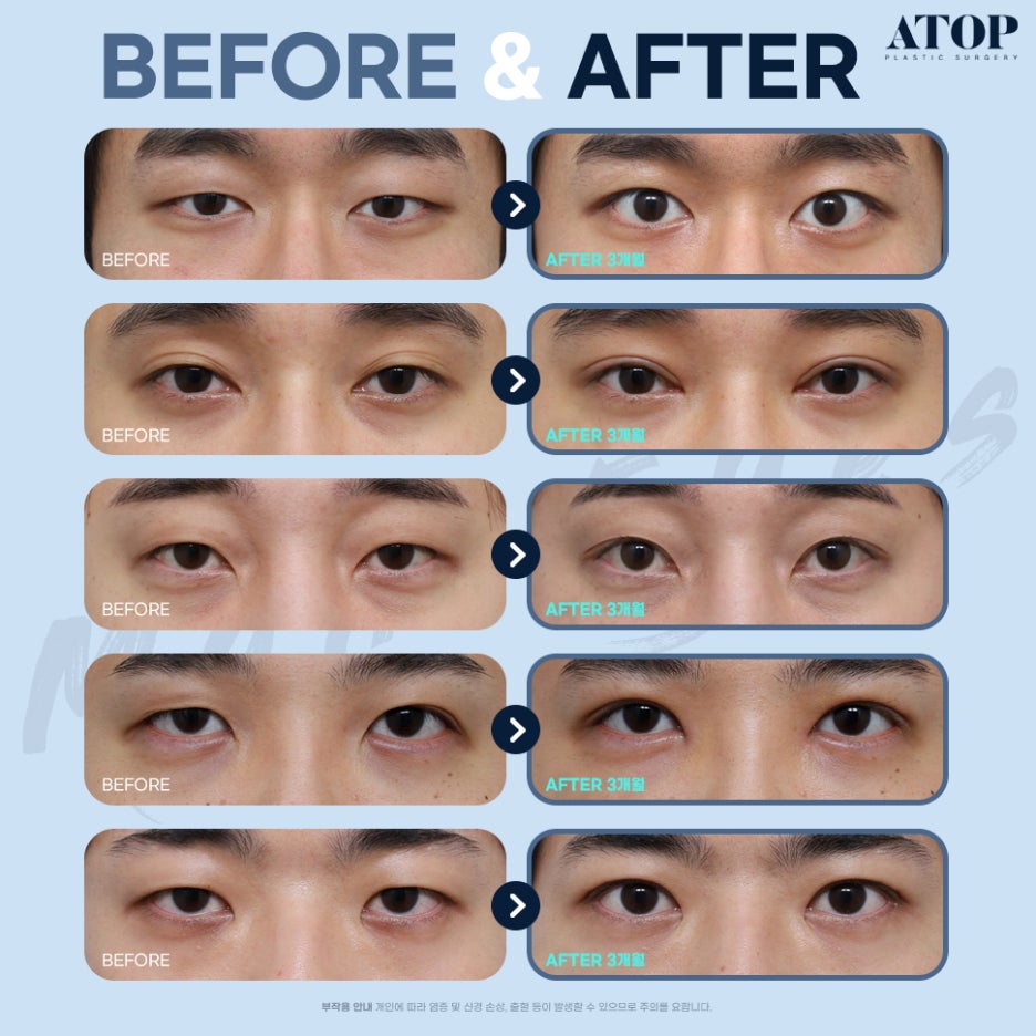 남자눈코성형 티 나지 않게 하는 것이 관건 관련 이미지 7