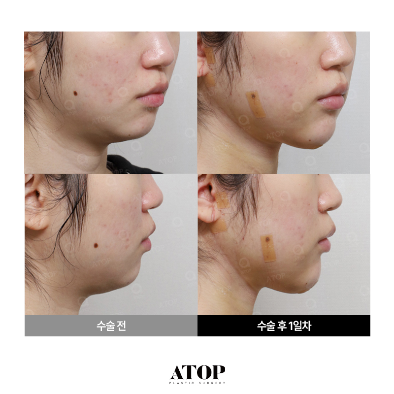 얼굴지방흡입 전후 차이, 라인 도드라지는 시기는? 관련 이미지 1
