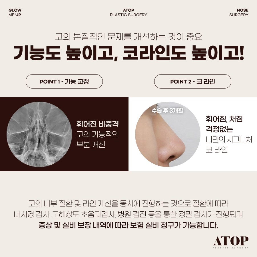 기능코성형, 코 모양은 물론 숨길을 함께 고려해야 하는 이유 관련 이미지 1