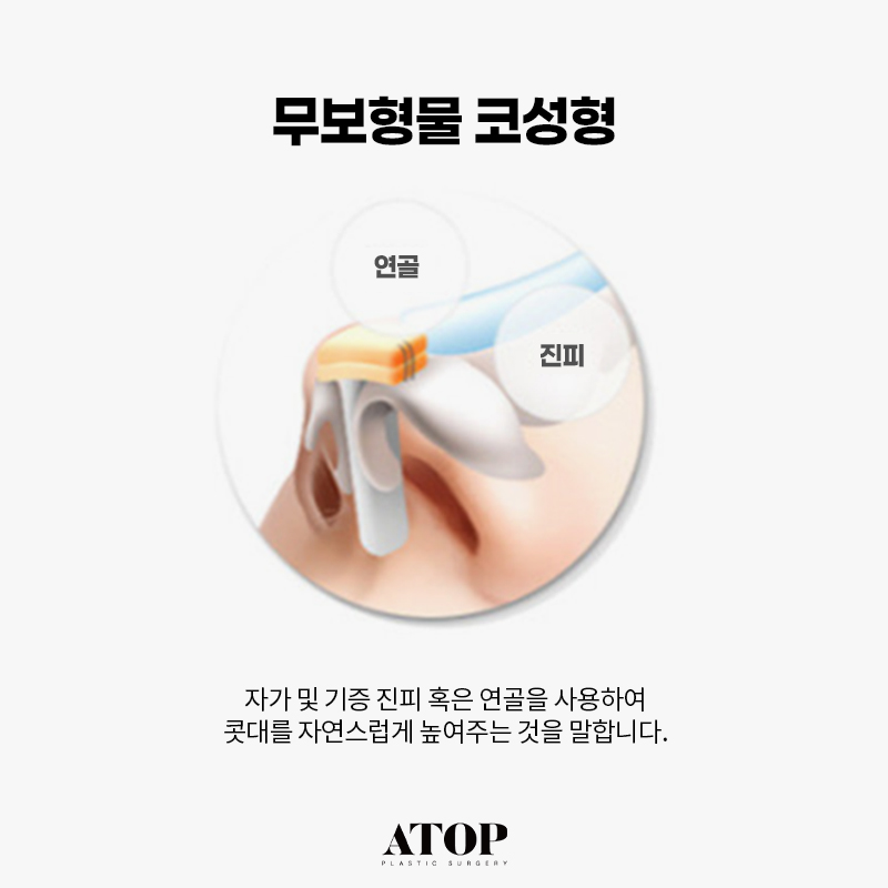 무보형물 코성형 만족도가 떨어질까? 관련 이미지 1