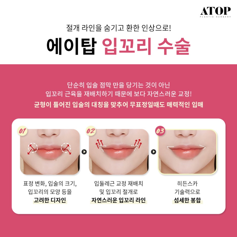 입꼬리수술잘하는곳 러블리한 입매가 될 수 있게 관련 이미지 4