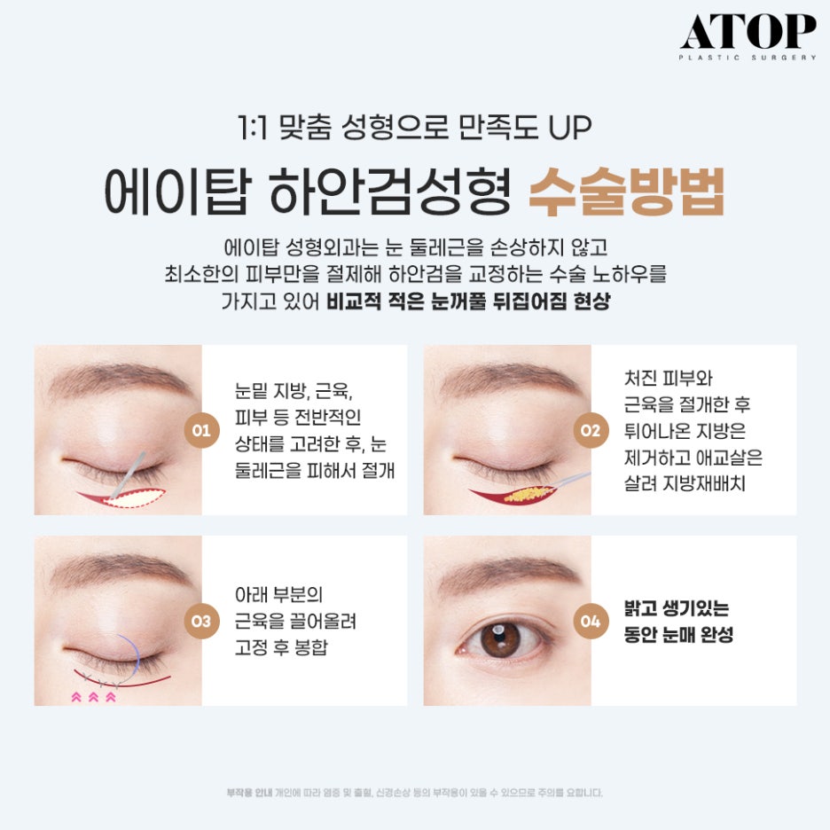 눈밑하안검수술 눈밑처짐까지 고민된다면? 관련 이미지 6