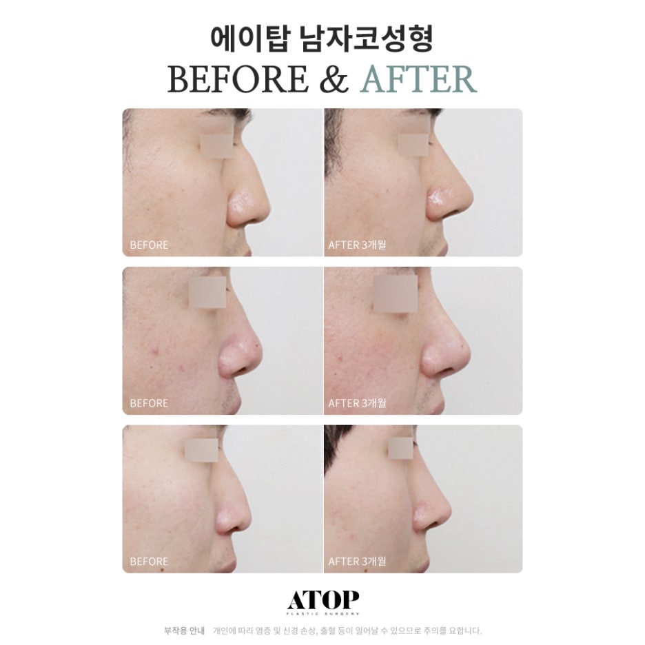 남자코성형잘하는곳 옆라인 살리는 자연스러움 관련 이미지 7