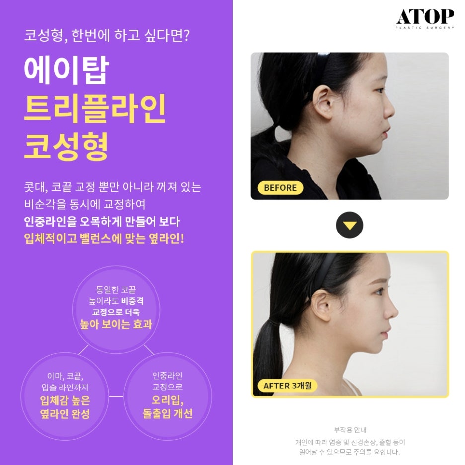 매부리코수술후기 내게 맞는 코 모양을 찾아 관련 이미지 2