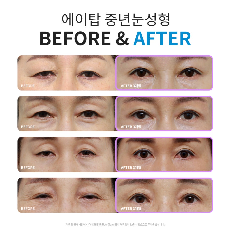 처진눈수술 중년의 눈을 또렷하게 관련 이미지 7
