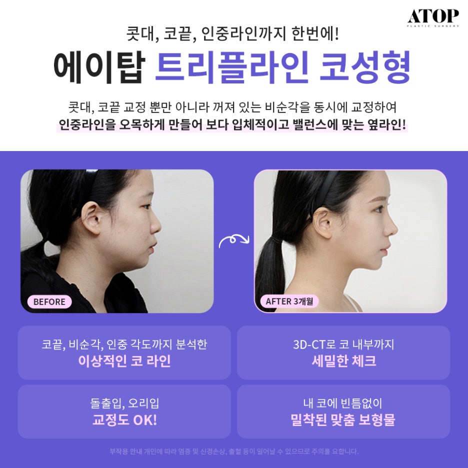 연예인성형외과 이목구비부터 얼굴형까지 부드러운 개선 관련 이미지 3