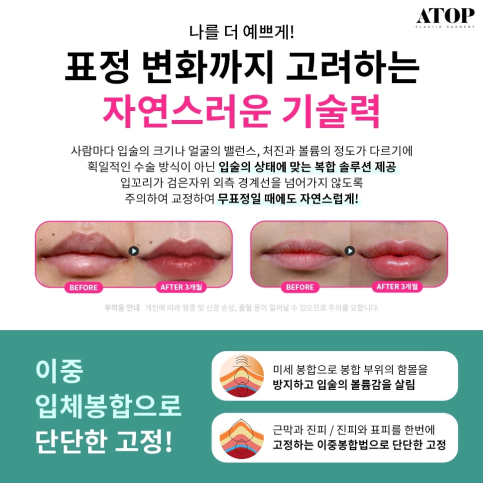 Gangnam Mouth Corner Surgery So Your Lips Match the Look You Want image 3