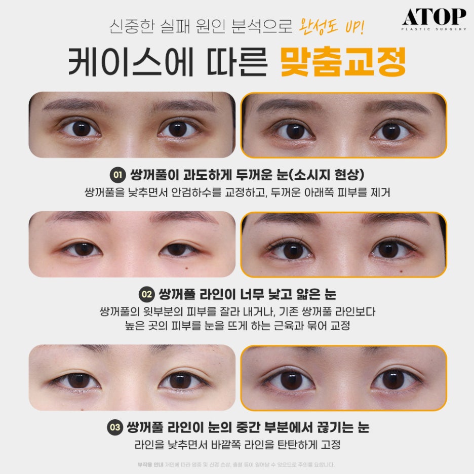 Gangnam Double Eyelid Revision Surgery: How to Fix “Sausage Eyes” and Double Creases? image 2
