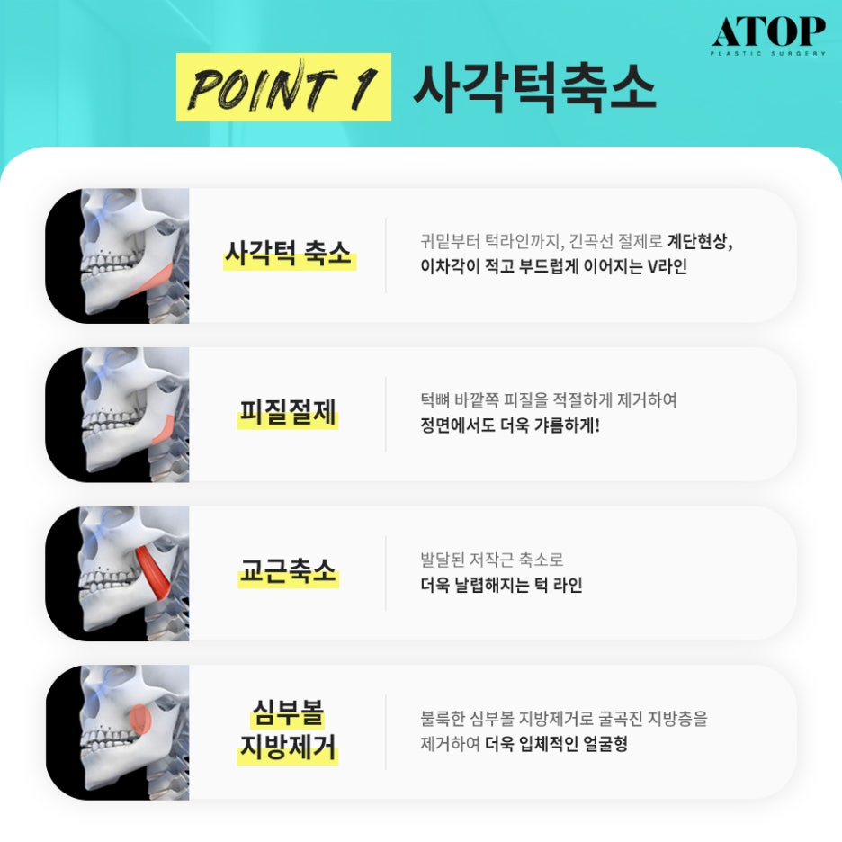 광대축소후기 크고 울퉁불퉁한 얼굴형 개선 관련 이미지 3