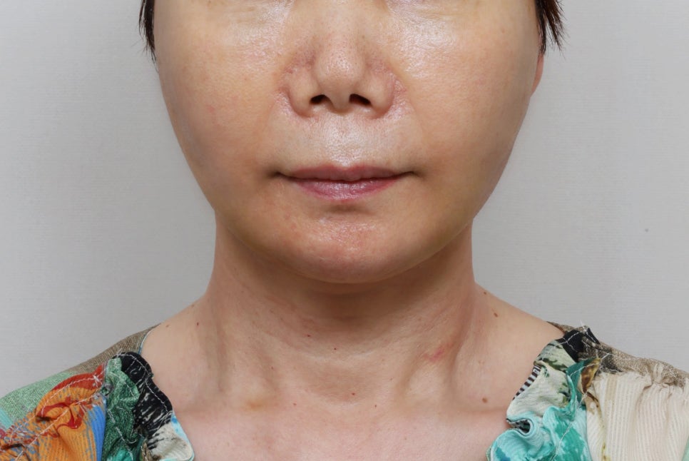 Facial rejuvenation surgery in the 60s [deep plane facelift revision] - A case of improving nasolabial folds, the midface, and jowls image 4