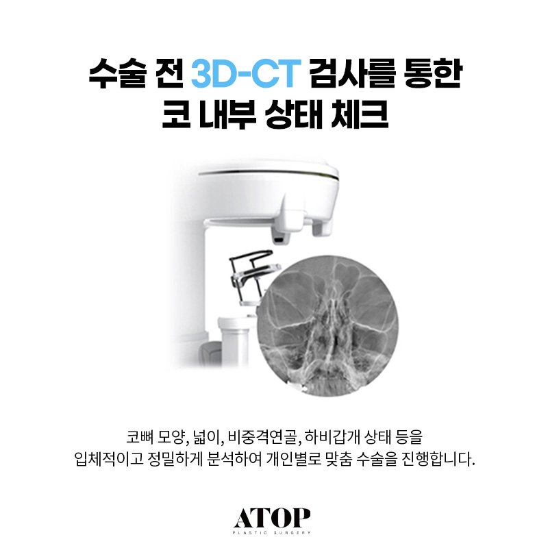 무보형물 코성형 만족도가 떨어질까? 관련 이미지 6