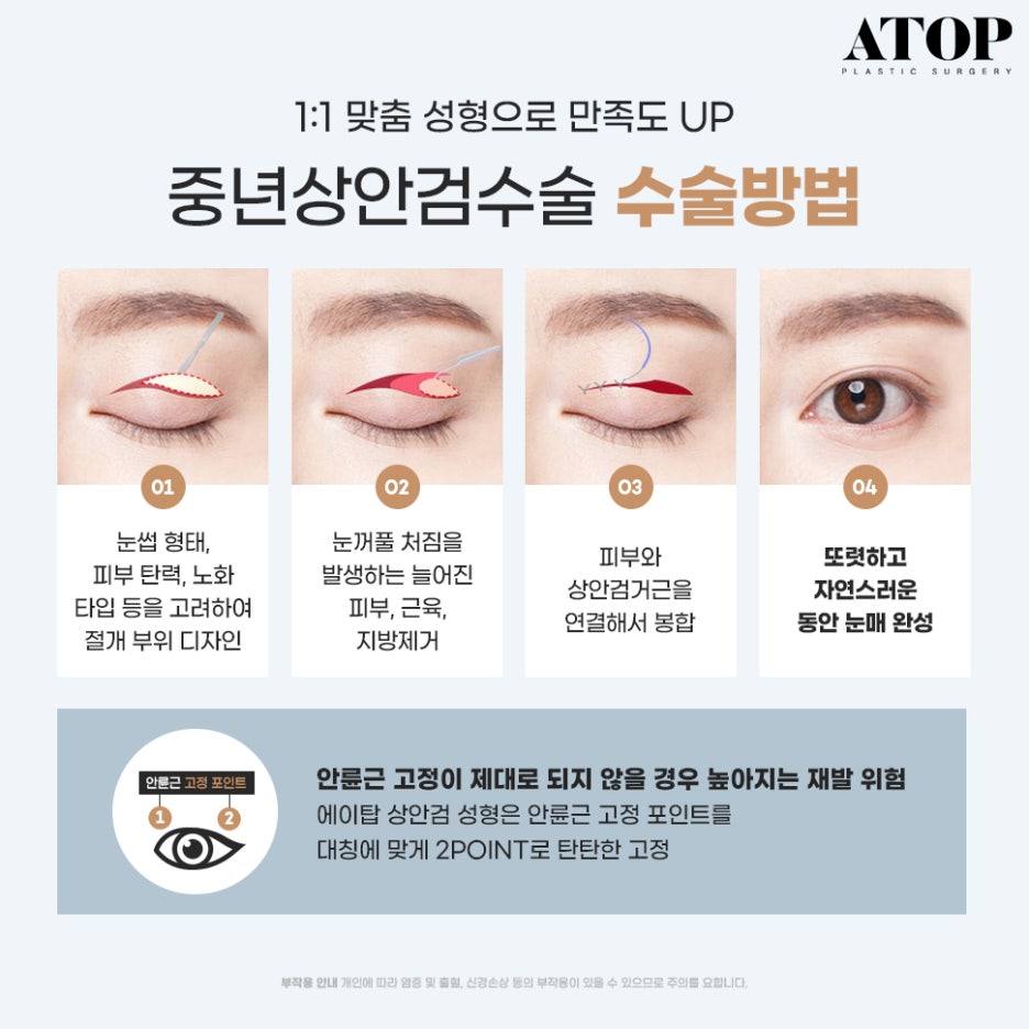 눈밑하안검수술 눈밑처짐까지 고민된다면? 관련 이미지 3