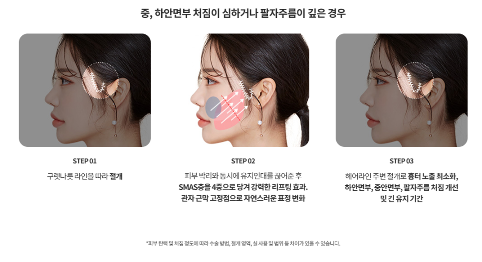 Mini Facelift Lifting That Also Improves Nasolabial Folds: Upgraded Yeo-woo Lifting image 2