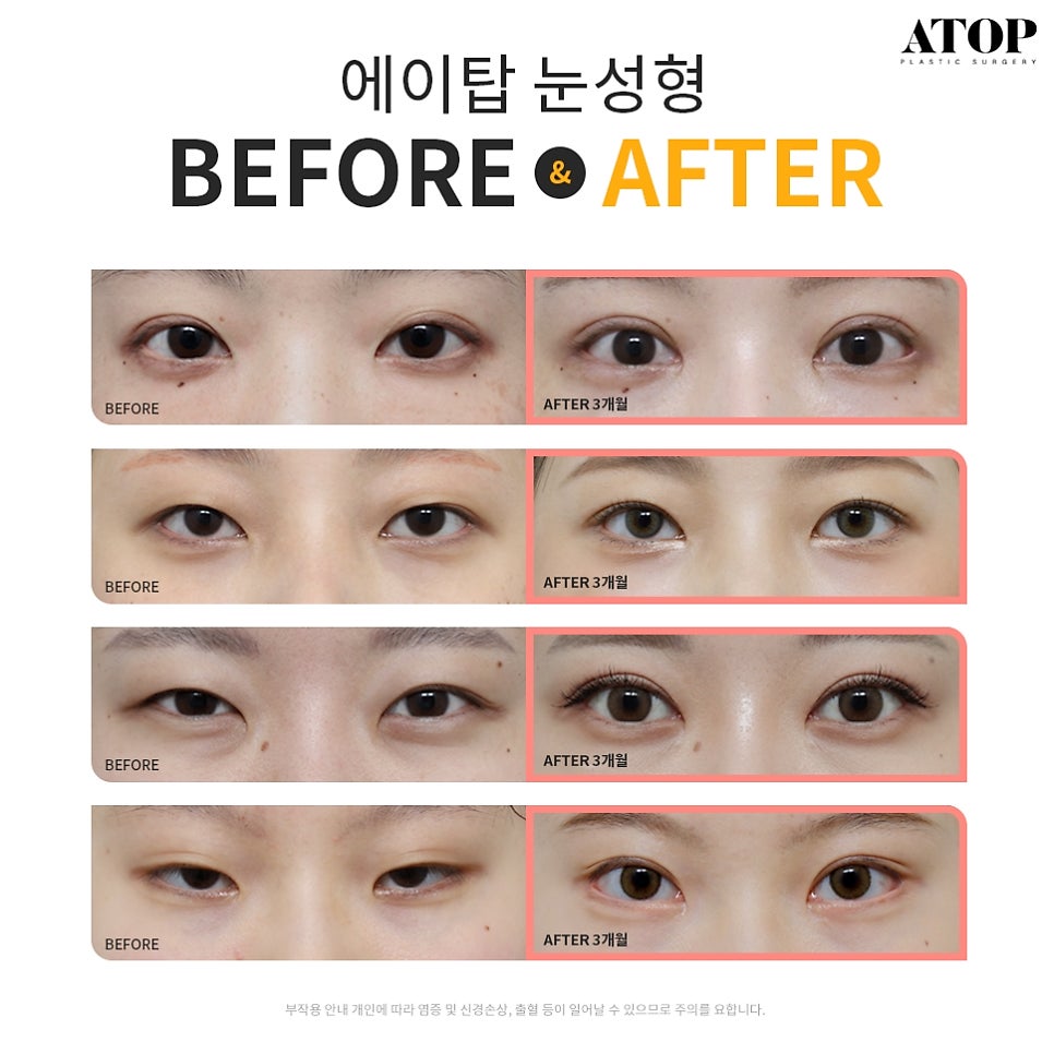 자연유착쌍수후기 핏한 쌍꺼풀과 트임으로 자연스럽게 관련 이미지 7
