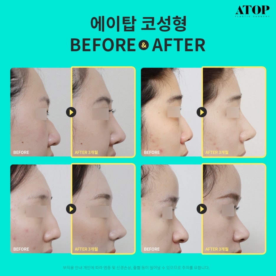 매부리코성형후기 차이나는 이유 관련 이미지 7