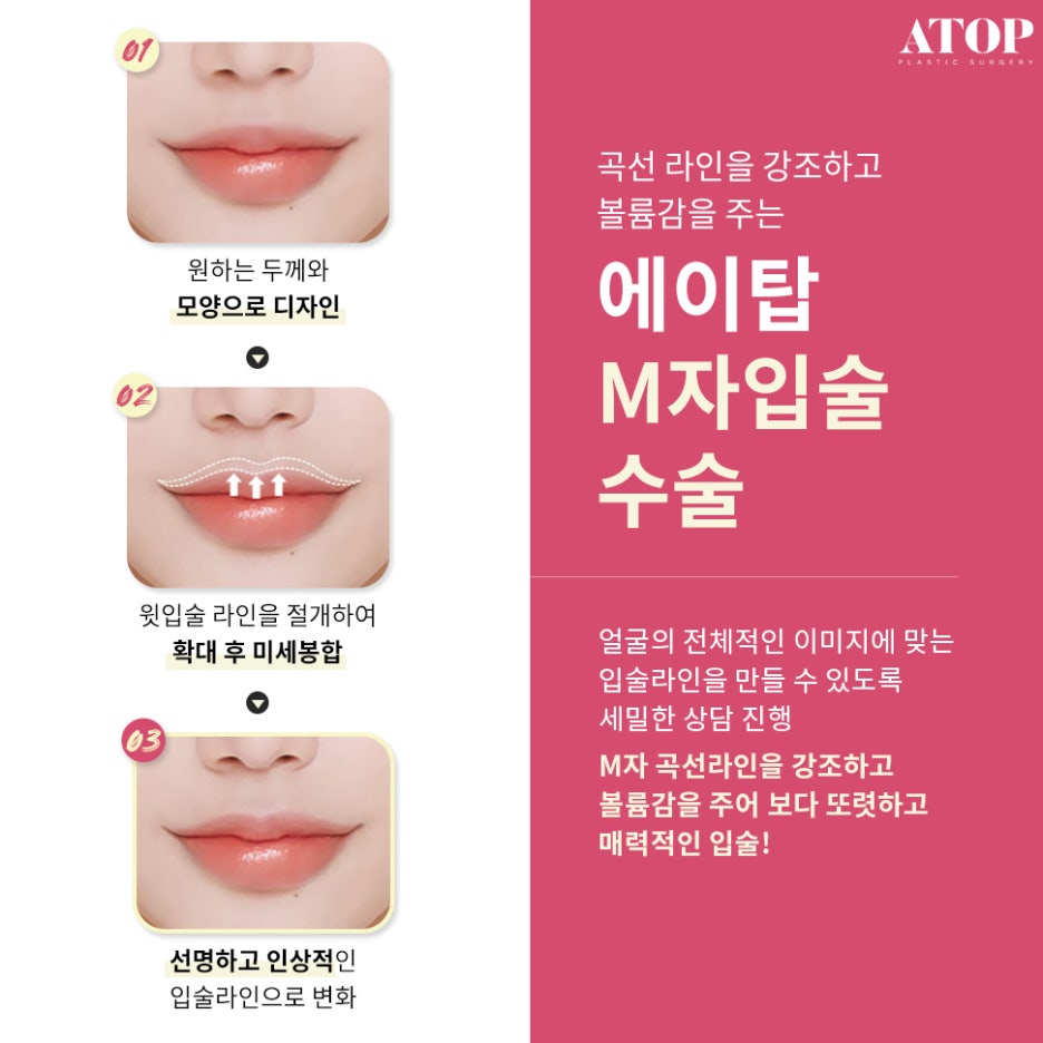입꼬리수술잘하는곳 러블리한 입매가 될 수 있게 관련 이미지 6
