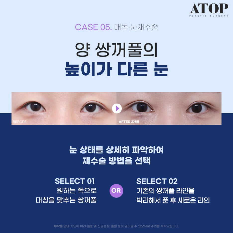 Where to Get Revision Eyelid Surgery Done Well: Surgical Methods Tailored to Eye Type image 6