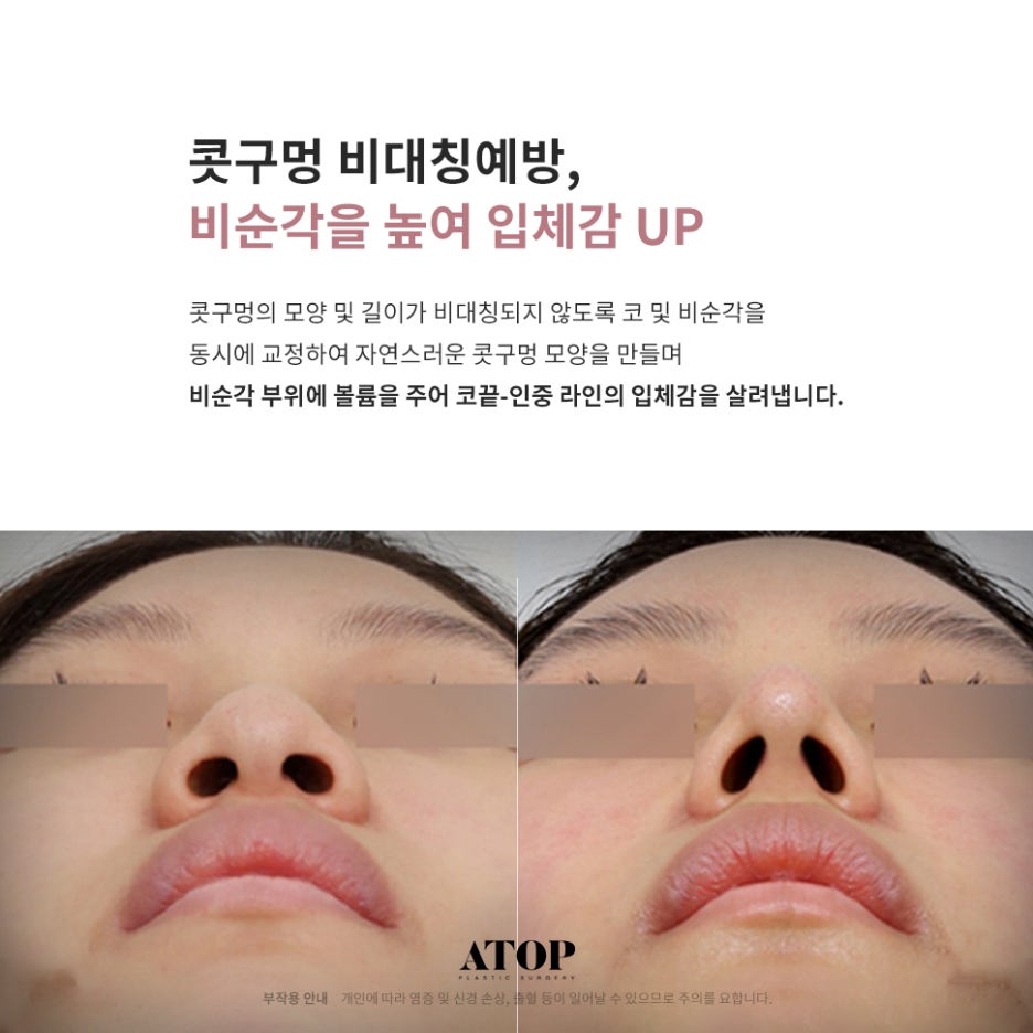 코끝성형비용 제대로 알고 계획해야 관련 이미지 2