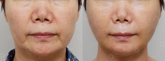Facial rejuvenation surgery in the 60s [deep plane facelift revision] - A case of improving nasolabial folds, the midface, and jowls image 7