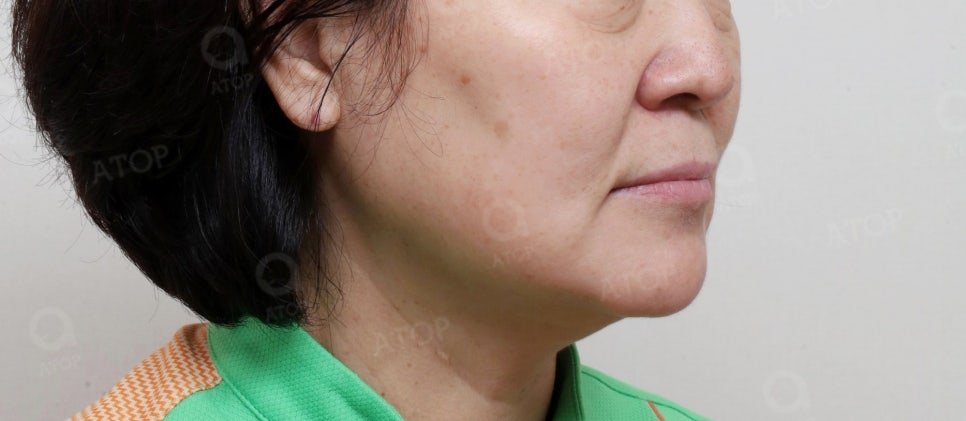 중년리프팅, 눈 밑 불룩한 고랑, 깊은 팔자주름 및 하안면부 처짐 수술 사례 관련 이미지 2