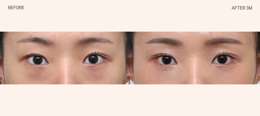 Is Lower Eyelid Fat Repositioning Surgery Simply About Removing Fat? image 3