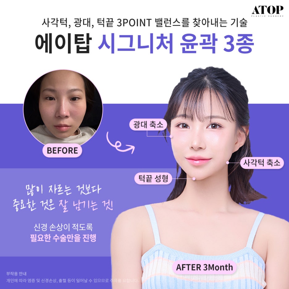 연예인성형외과 이목구비부터 얼굴형까지 부드러운 개선 관련 이미지 2