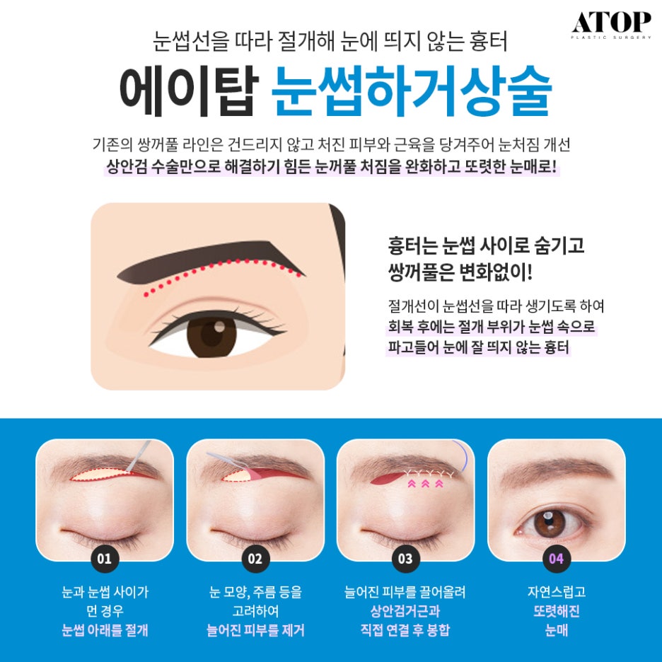 처진눈수술 중년의 눈을 또렷하게 관련 이미지 6