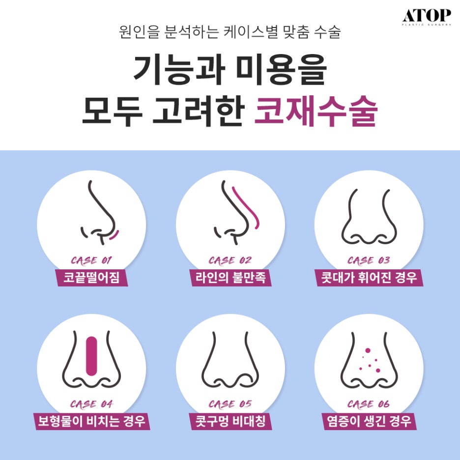 A Deviated Nose Revision Surgery Should Be Different the First Time and the Second Time image 3