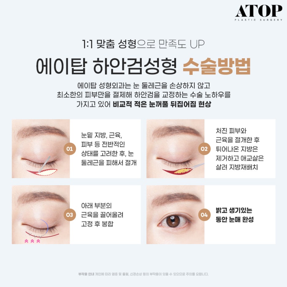 중년눈밑지방 눈꺼풀이 계속 처진다면? 관련 이미지 6