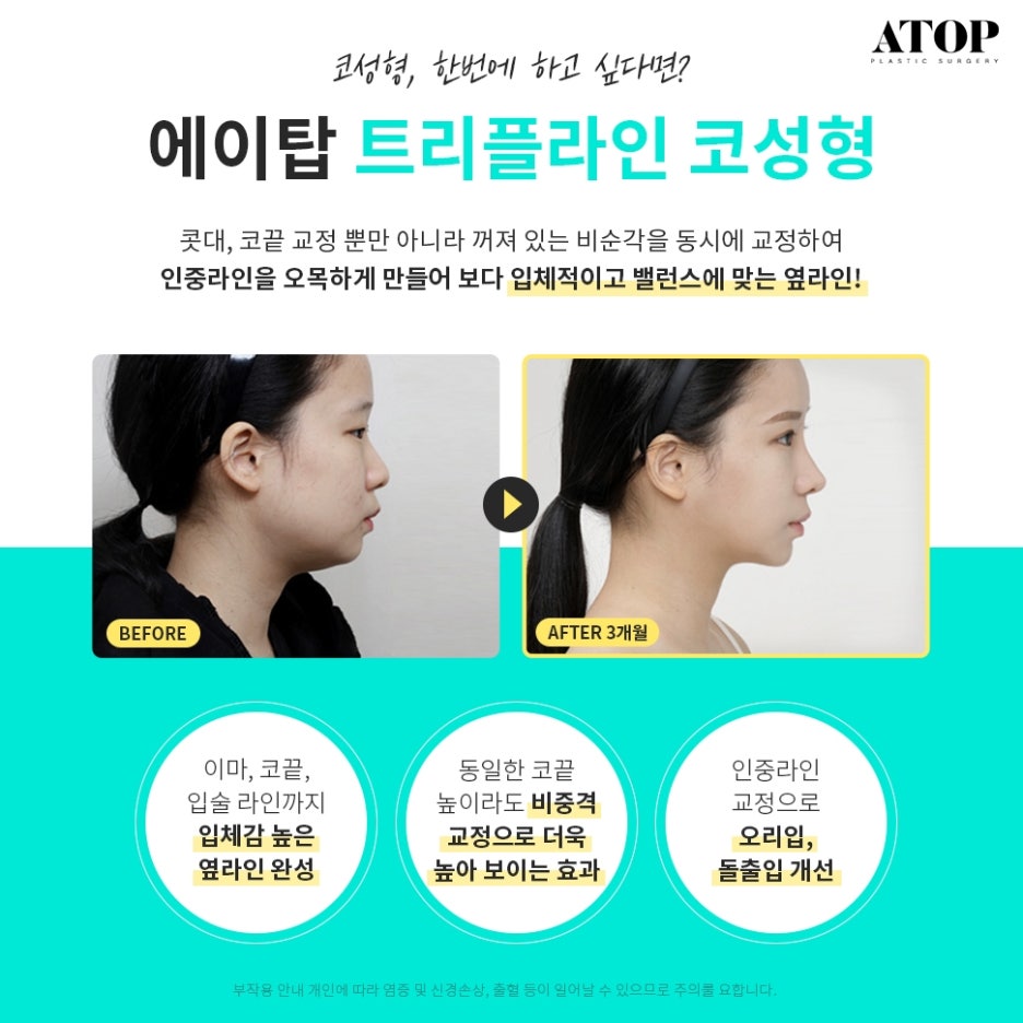 매부리코성형후기 차이나는 이유 관련 이미지 2