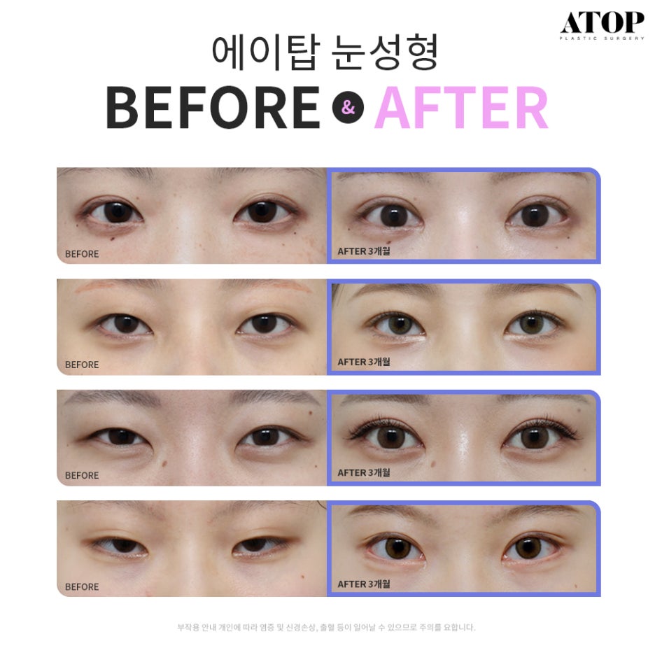 Natural Adhesion Double Eyelid Review: Confidence Boosted with a Face-Fitting Procedure image 7