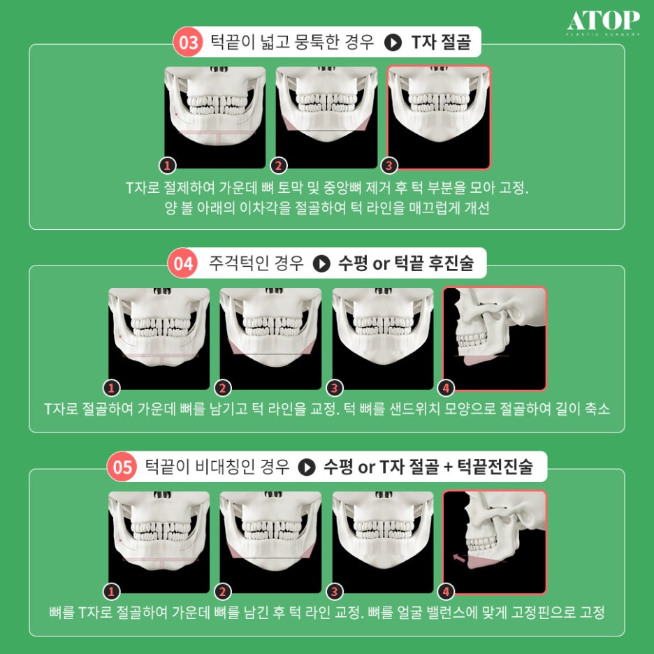 Genioplasty with a Plan Suited to My Chin Shape image 4