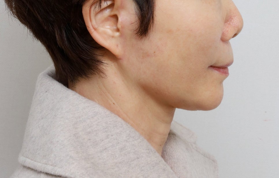 Facial rejuvenation surgery in the 60s [deep plane facelift revision] - A case of improving nasolabial folds, the midface, and jowls image 6