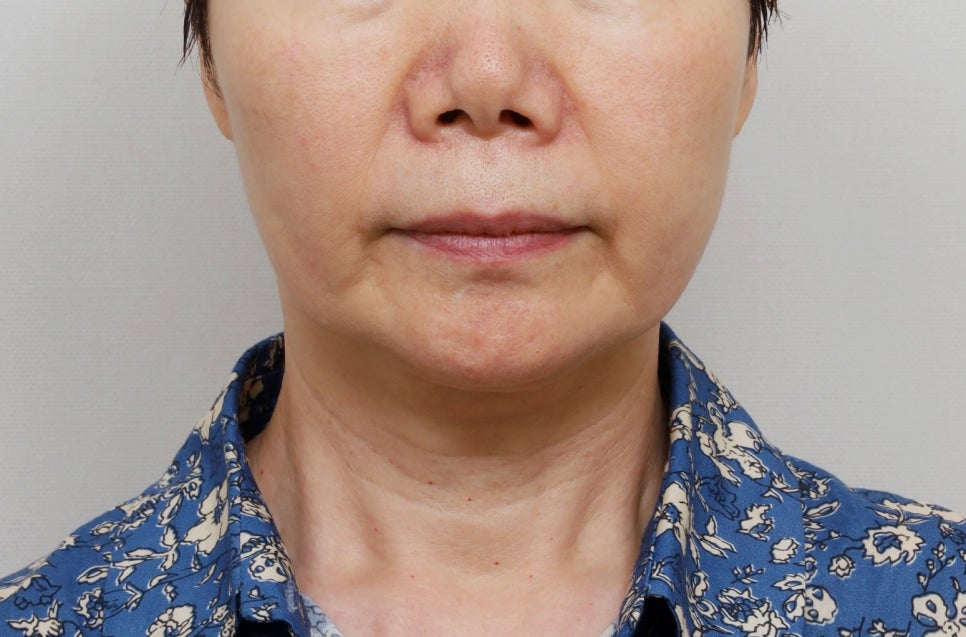 Facial rejuvenation surgery in the 60s [deep plane facelift revision] - A case of improving nasolabial folds, the midface, and jowls image 1
