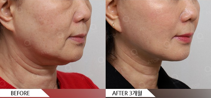 Mini Facelift Lifting That Also Improves Nasolabial Folds: Upgraded Yeo-woo Lifting image 4