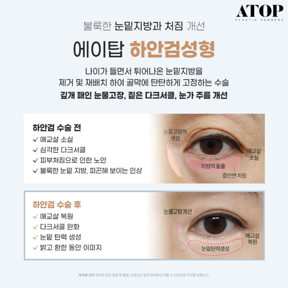 중년눈밑지방 눈꺼풀이 계속 처진다면? 관련 이미지 5