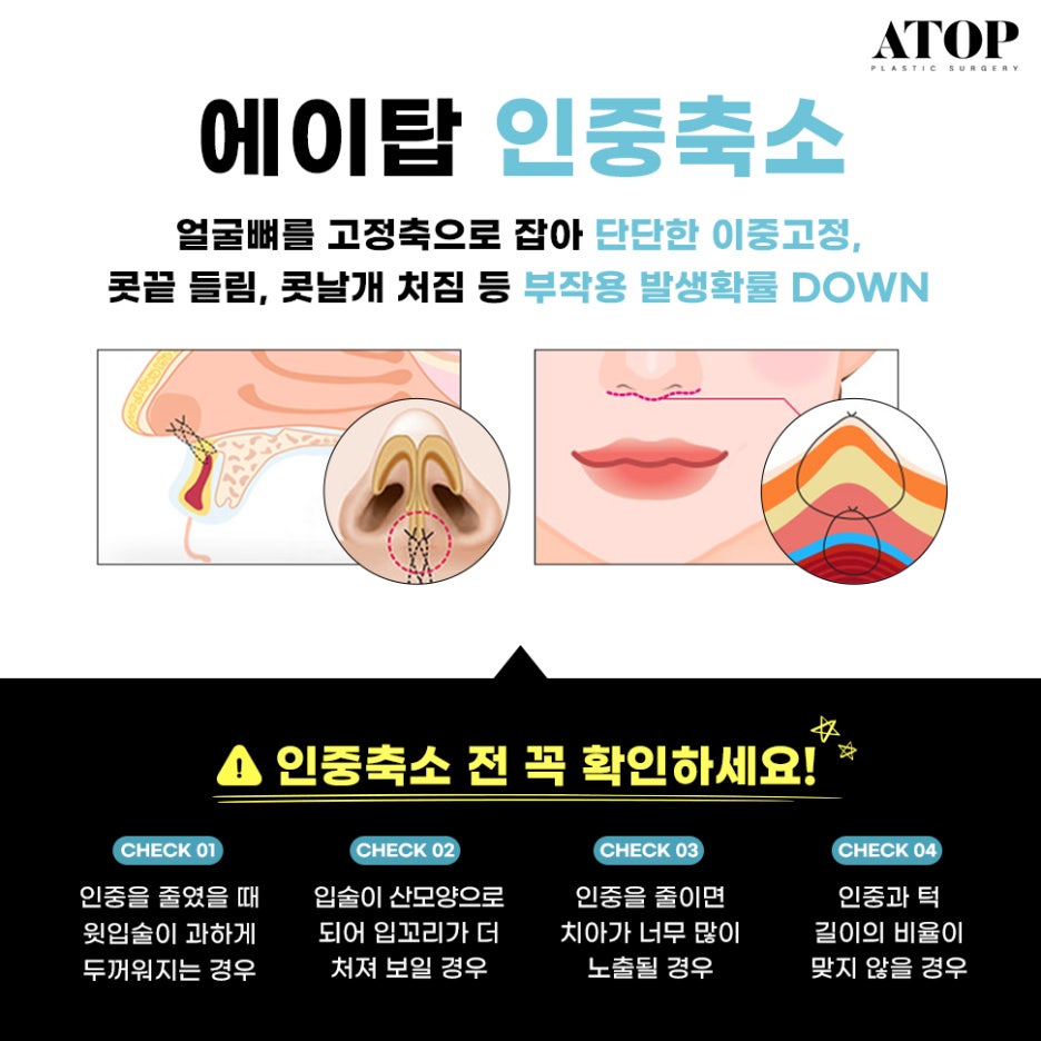 인중축소수술후기 최대 줄일 수 있는 길이는? 관련 이미지 4
