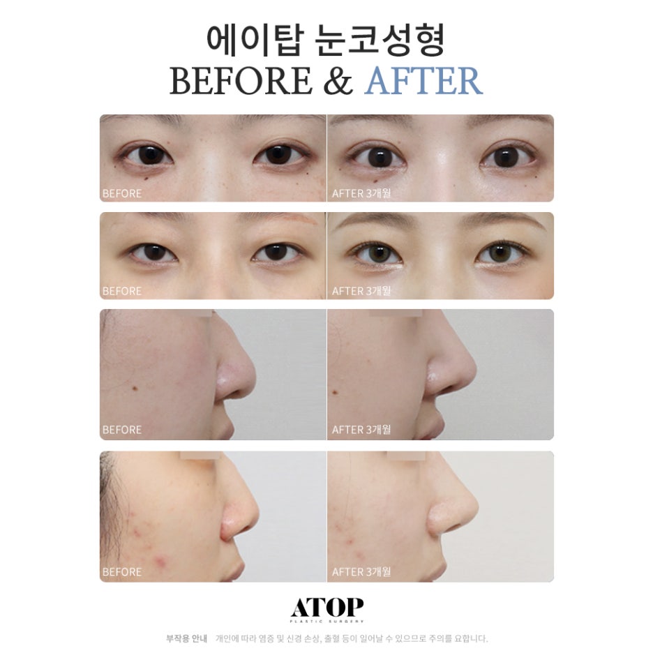 눈코성형비용  이목구비 조화로운 맞춤 디자인으로 관련 이미지 7