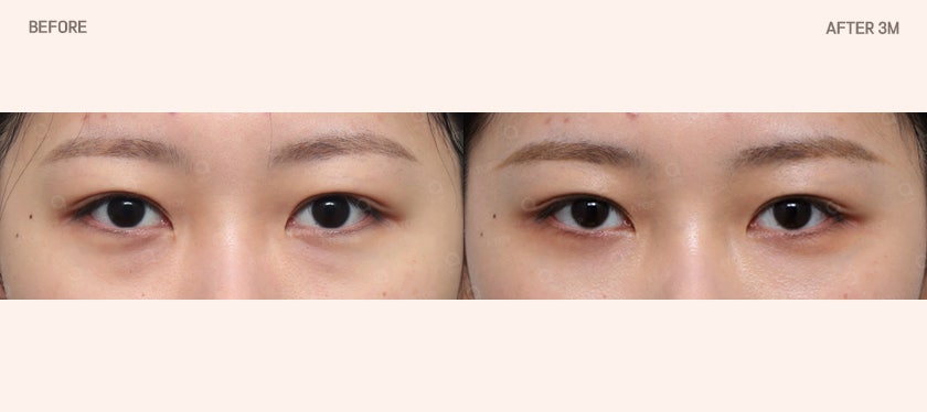 Is Lower Eyelid Fat Repositioning Surgery Simply About Removing Fat? image 2