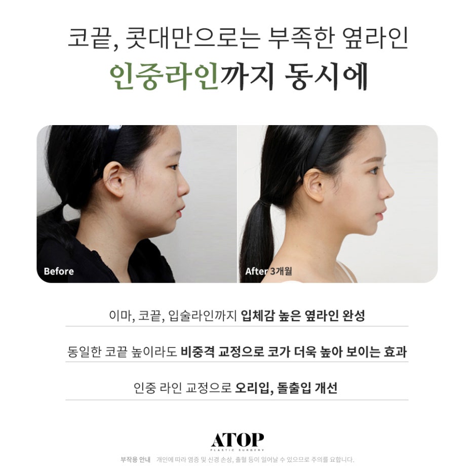 눈코성형비용  이목구비 조화로운 맞춤 디자인으로 관련 이미지 3